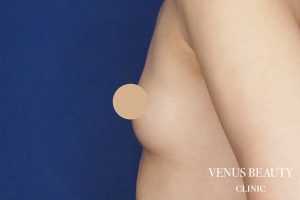 脂肪注入豊胸 施術前