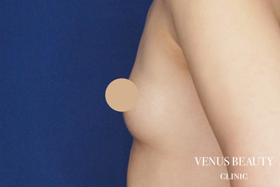 脂肪注入豊胸 施術前