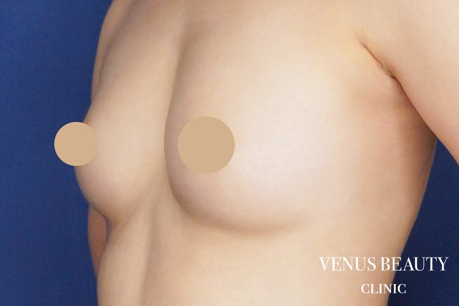 脂肪注入豊胸 施術後