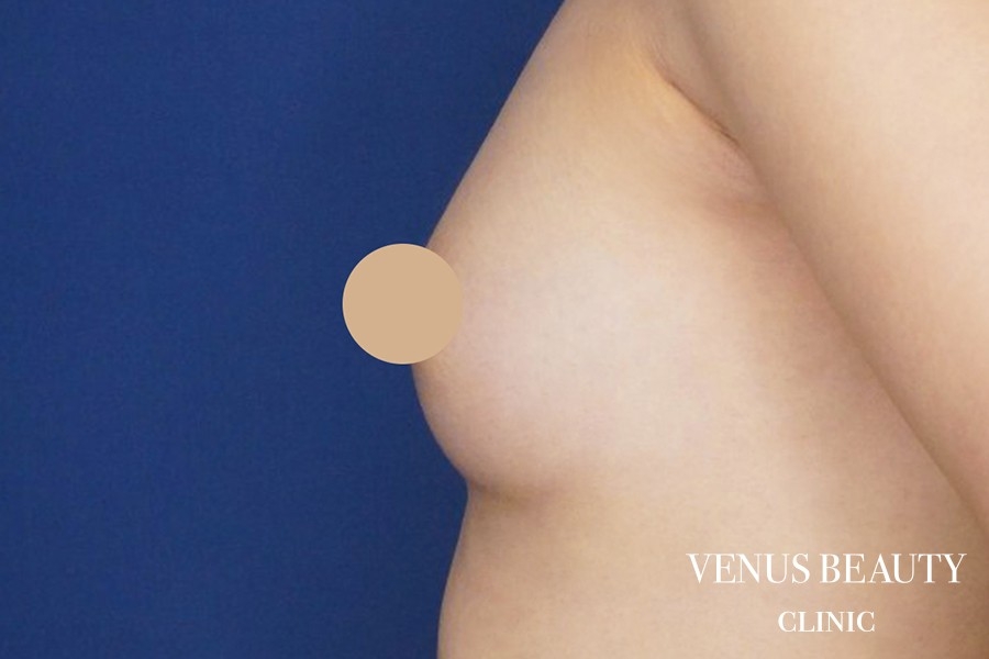 脂肪注入豊胸 施術後