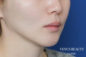 ダブロゴールド 施術後