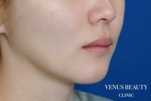 ダブロゴールド 施術前