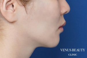 ダブロゴールド 施術後