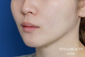 ダブロゴールド 施術後