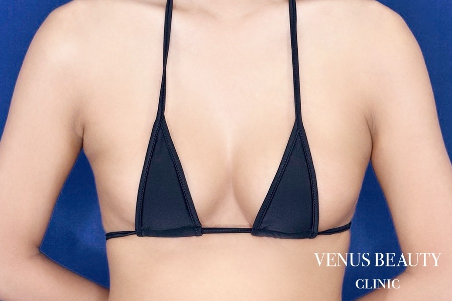 シリコン豊胸 施術前