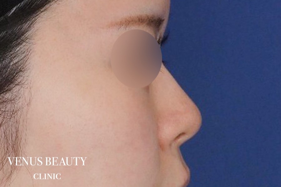 わし鼻・段鼻修正 ハンプ切除 施術前