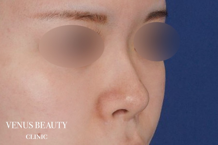 わし鼻・段鼻修正 ハンプ切除 施術前