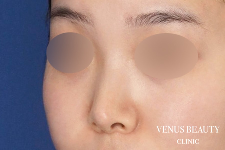 鼻尖形成 施術後