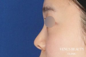 鼻尖形成 施術後