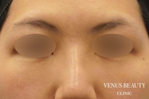 下まぶたのたるみとり 施術後