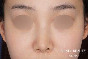 鼻尖形成 施術後