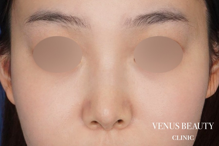 鼻尖形成 施術後