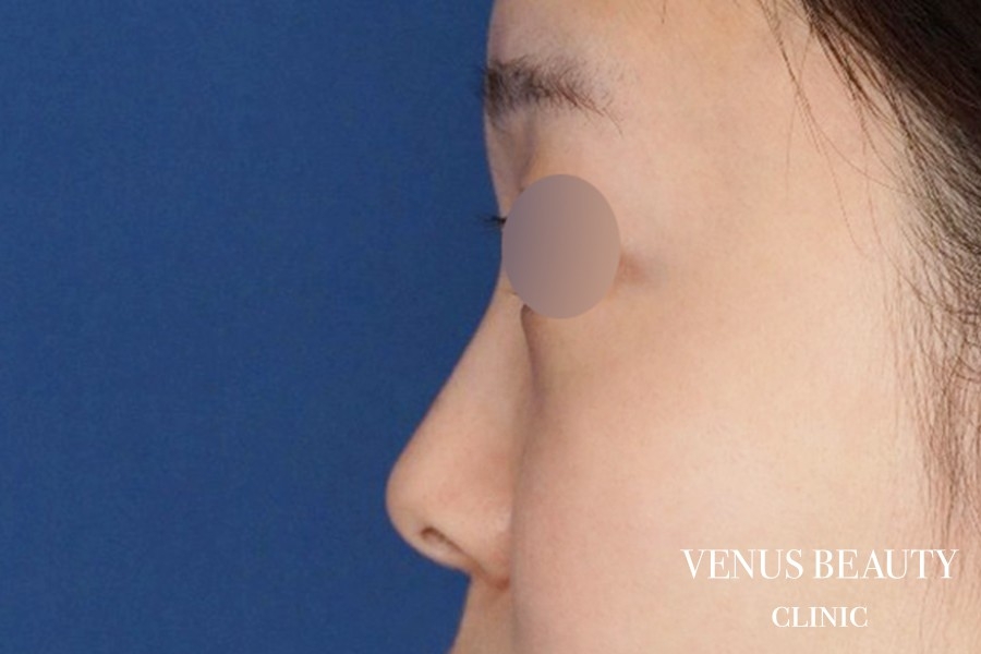 鼻尖形成 施術前