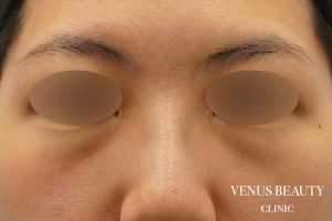 下まぶたのたるみとり 施術前