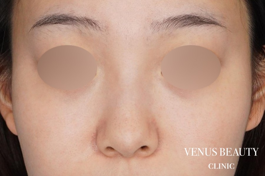 鼻尖形成 施術前